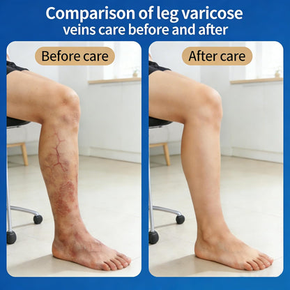 Instant Leg Relief: Micro-Dart Patches to End Throbbing Vein Pain