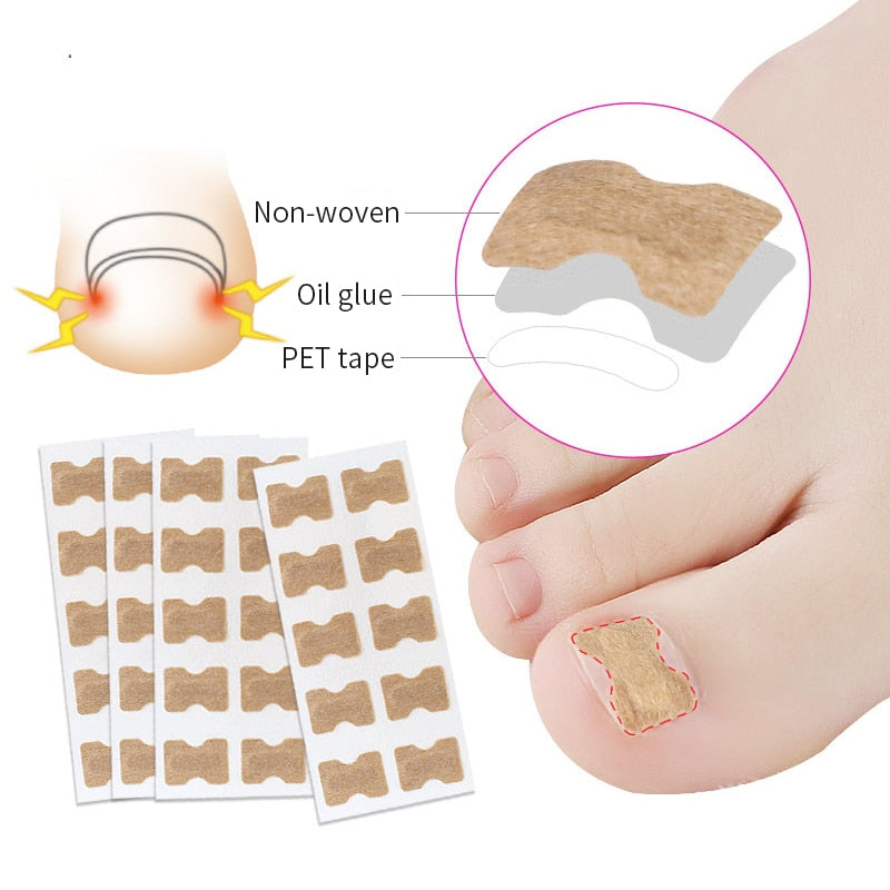 Toe Align Ingrown Nail Corrector Stickers - Image 2